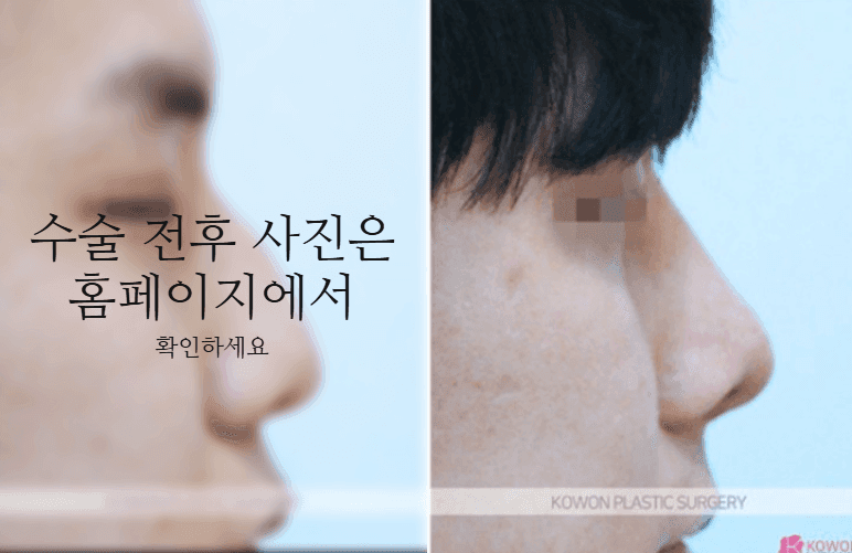 비중격만곡증 수술 회복기간과 매부리·휜코를 함께 교정하는 이유 관련 이미지 10/11
