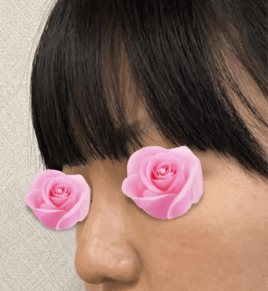 코수술 후 코끝이 다시 떨어지는 이유 — 코끝내림근과 재수술 설계 관련 이미지 1/20