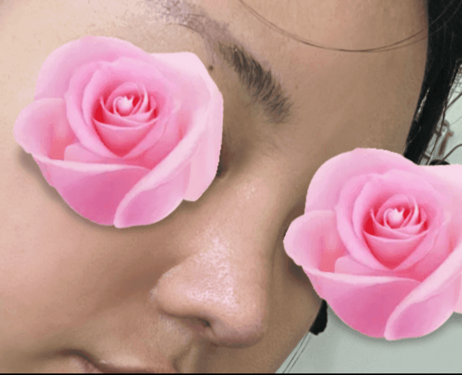 코수술 후 코끝이 다시 떨어지는 이유 — 코끝내림근과 재수술 설계 관련 이미지 6/20