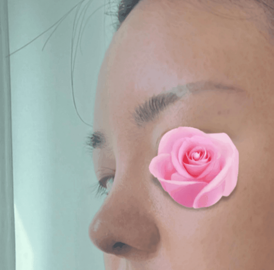 코수술 후 코끝이 다시 떨어지는 이유 — 코끝내림근과 재수술 설계 관련 이미지 7/20