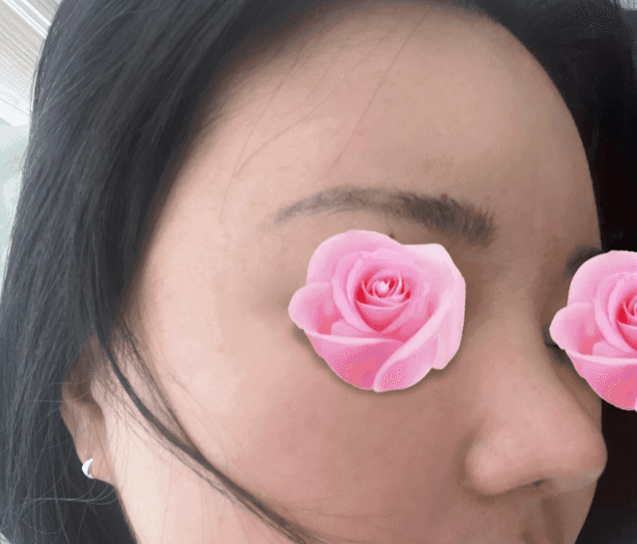 코수술 후 코끝이 다시 떨어지는 이유 — 코끝내림근과 재수술 설계 관련 이미지 8/20
