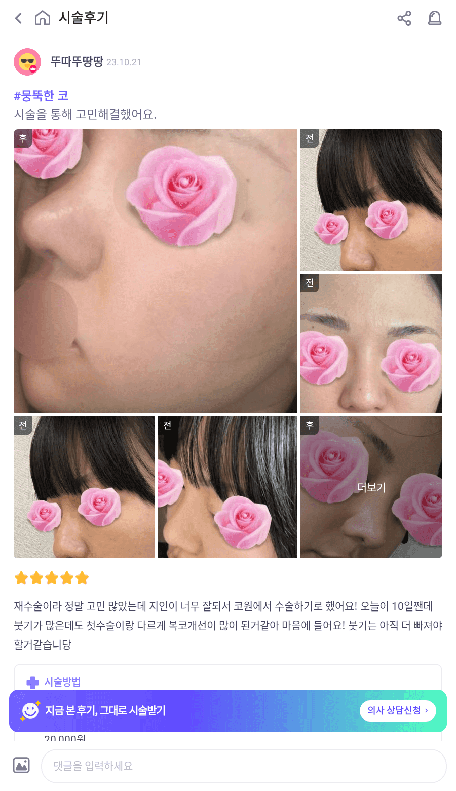 코수술 후 코끝이 다시 떨어지는 이유 — 코끝내림근과 재수술 설계 관련 이미지 9/20