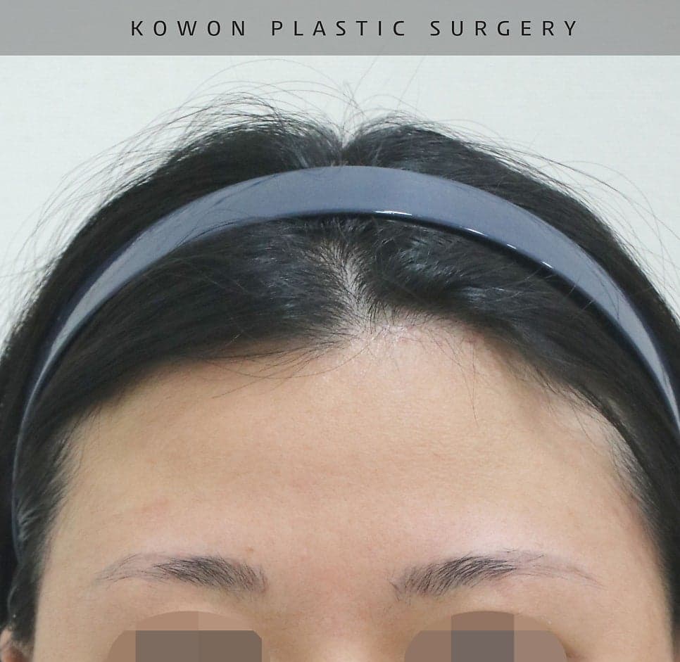 코수술 후 코끝이 다시 떨어지는 이유 — 코끝내림근과 재수술 설계 관련 이미지 17/20