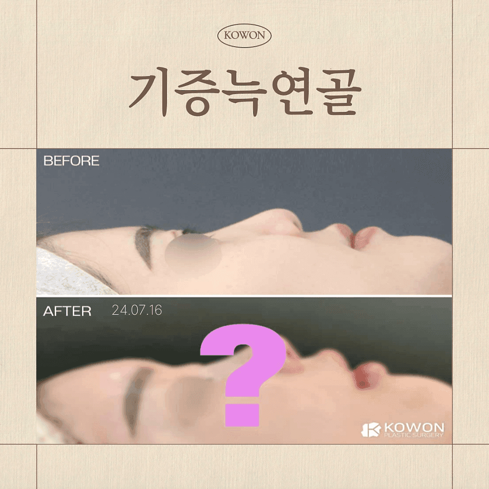 기증늑연골 장점과 단점 — 코성형 연골 선택은 무엇을 보고 정하나요? 관련 이미지 1/9