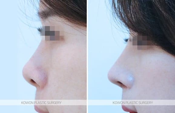 기증늑연골 수술 3주, 코끝이 들려 들창코 같아 보인다면 — 부기와 재수술 사이에서 확인할 것 관련 이미지 3/5