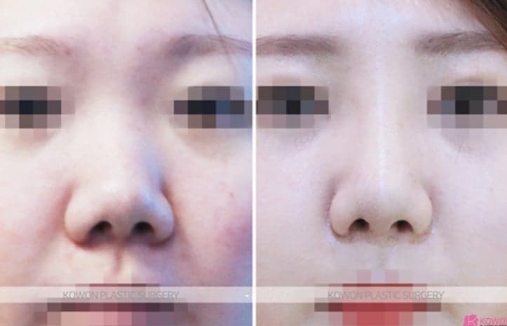 기증늑연골 수술 3주, 코끝이 들려 들창코 같아 보인다면 — 부기와 재수술 사이에서 확인할 것 관련 이미지 5/5