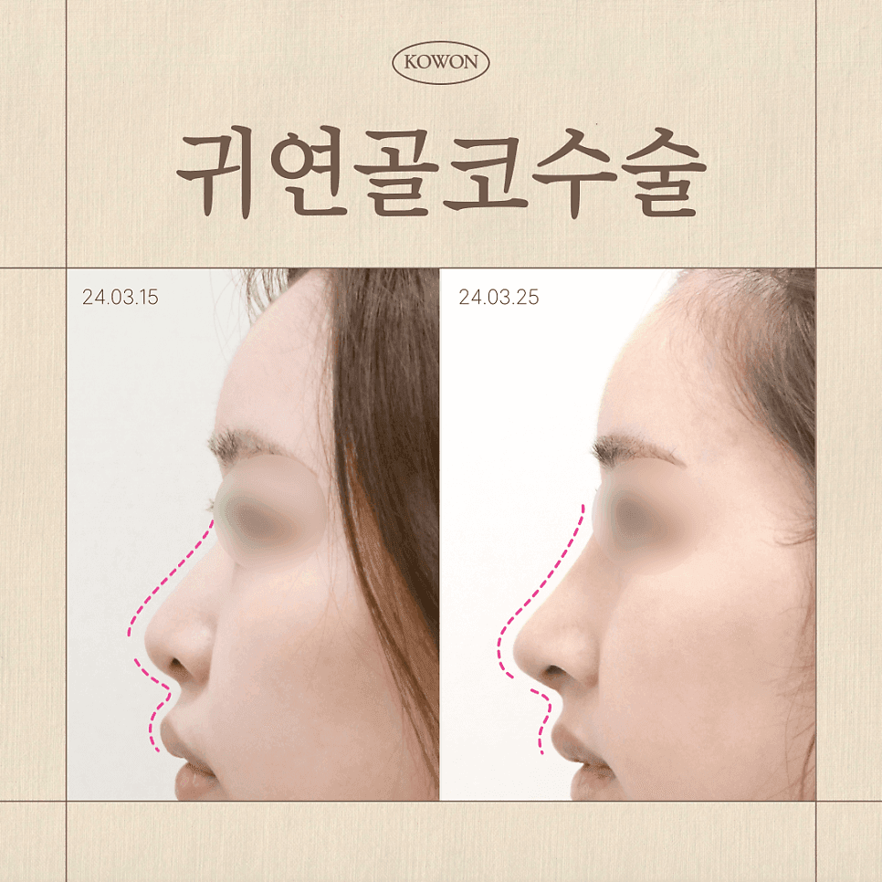 귀연골코수술, 코끝 모양과 지지력을 함께 보는 기준 — 언제 귀연골이고 언제 아닌가 관련 이미지 1/5