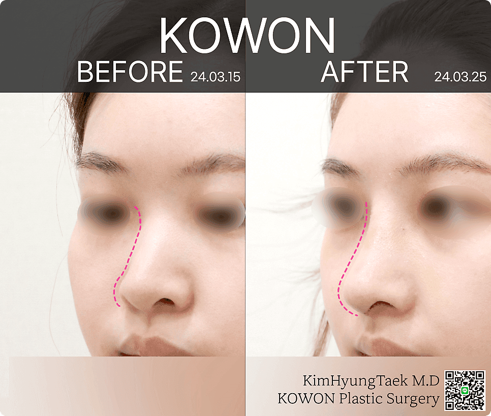 귀연골코수술, 코끝 모양과 지지력을 함께 보는 기준 — 언제 귀연골이고 언제 아닌가 관련 이미지 5/5