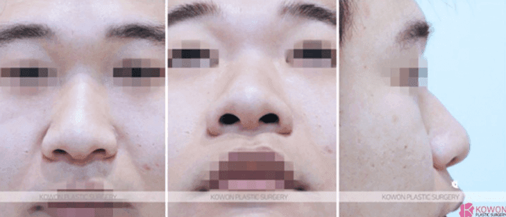 Image 5/10 for: ear cartilage site pain 3 years after rhinoplasty — the criteria for telling a side effect from pressed irritation