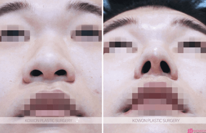 อาการปวดกระดูกอ่อนหู 3 ปีหลังการผ่าตัดจมูก— เกณฑ์ในการแยกแยะระหว่างผลข้างเคียงและการระคายเคืองจากแรงกด ภาพที่ 7/10