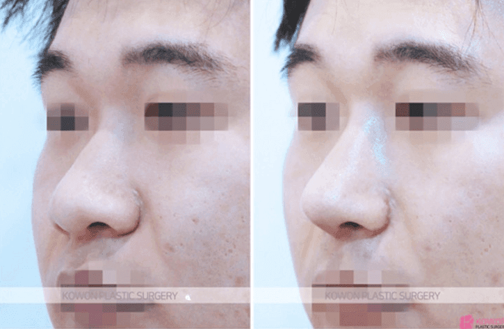 อาการปวดกระดูกอ่อนหู 3 ปีหลังการผ่าตัดจมูก— เกณฑ์ในการแยกแยะระหว่างผลข้างเคียงและการระคายเคืองจากแรงกด ภาพที่ 9/10