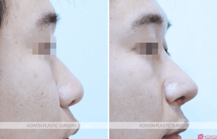อาการปวดกระดูกอ่อนหู 3 ปีหลังการผ่าตัดจมูก— เกณฑ์ในการแยกแยะระหว่างผลข้างเคียงและการระคายเคืองจากแรงกด ภาพที่เกี่ยวข้อง 10/10