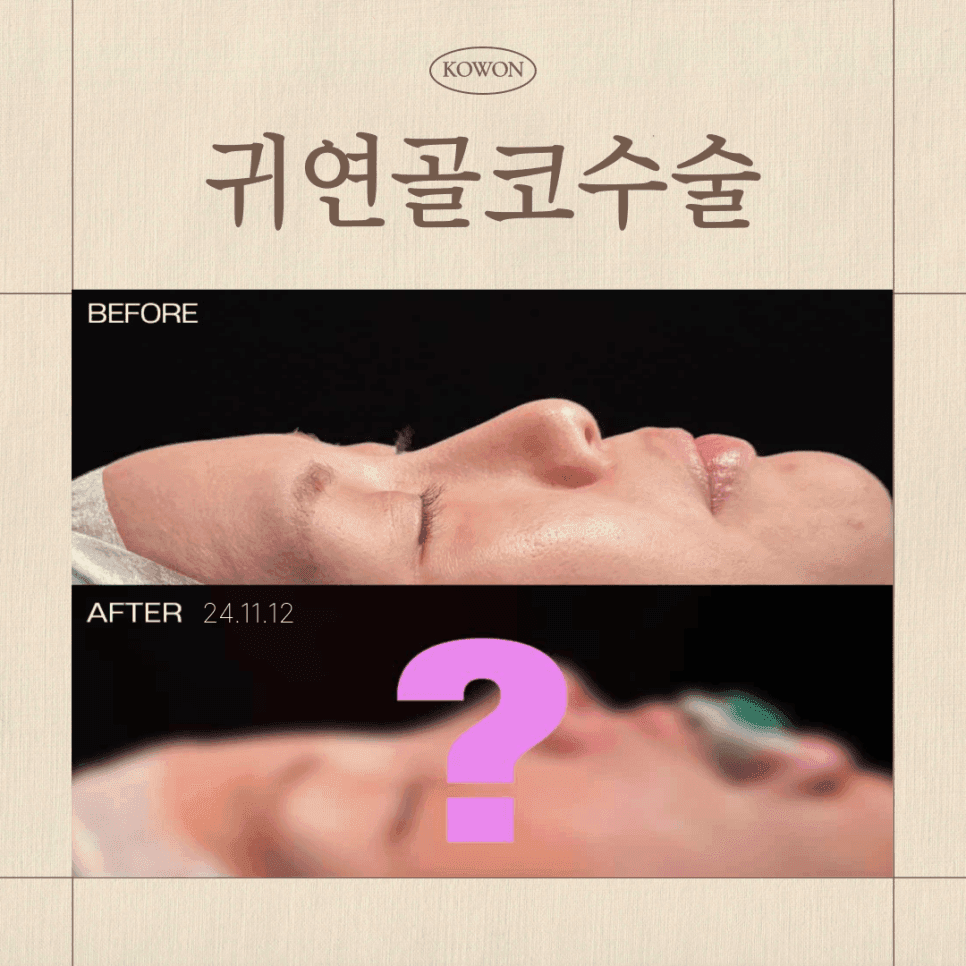 การผ่าตัดจมูก กระดูกอ่อนหูแตกต่างจากกระดูกอ่อนซี่โครง ผนังกั้นช่องจมูกอ่อนซี่โครงอย่างไร? — เกณฑ์การเลือกวัสดุตามสภาพจมูก ภาพที่เกี่ยวข้อง 1/5