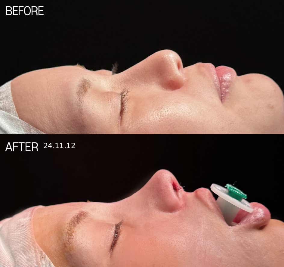 귀연골코수술, 비중격·늑연골과 무엇이 다른가요 — 코 상태별 재료 선택 기준 관련 이미지 2/5