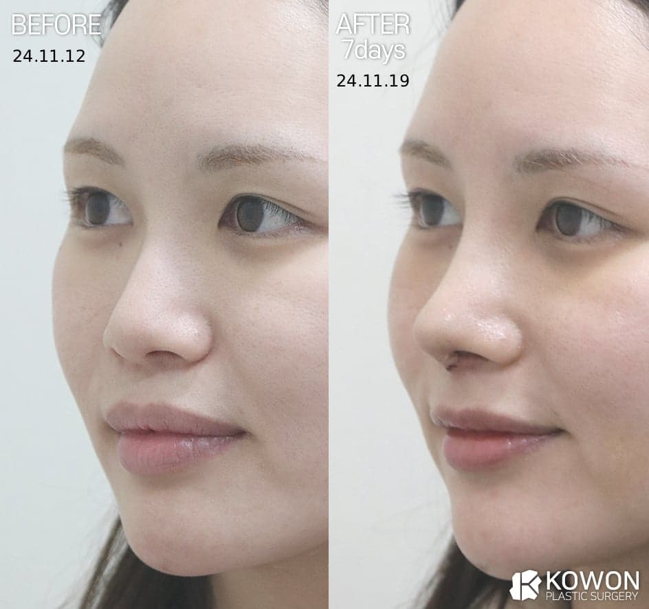 귀연골코수술, 비중격·늑연골과 무엇이 다른가요 — 코 상태별 재료 선택 기준 관련 이미지 4/5