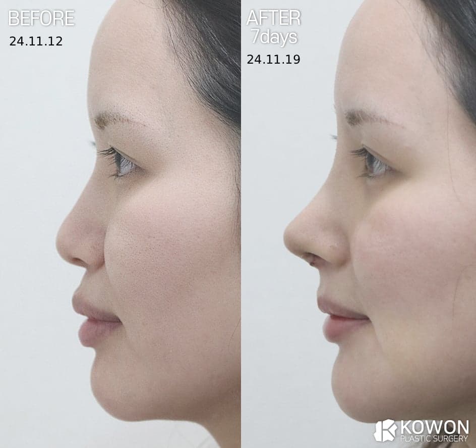 귀연골코수술, 비중격·늑연골과 무엇이 다른가요 — 코 상태별 재료 선택 기준 관련 이미지 5/5