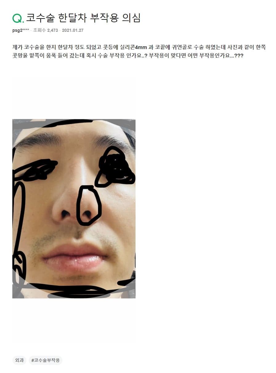 코끝 귀연골 수술 한 달, 한쪽 콧망울 밑이 파여 보인다면 — 부작용과 경계 현상 구분 관련 이미지 2/2