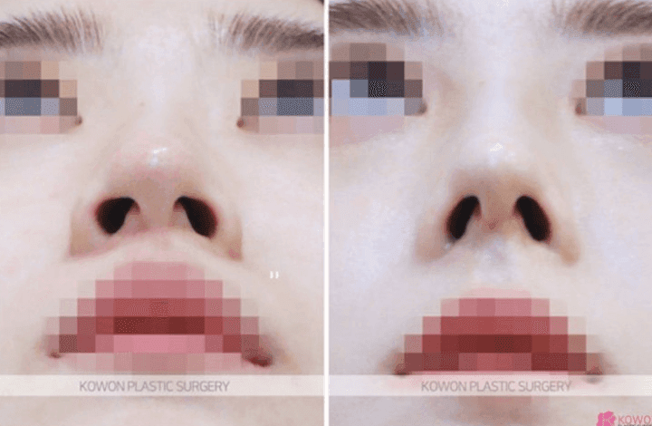 코끝성형 10일차에 코를 쳤는데 아파요 — 코성형통증이 가라앉는 시점과 변형 걱정 관련 이미지 5/5