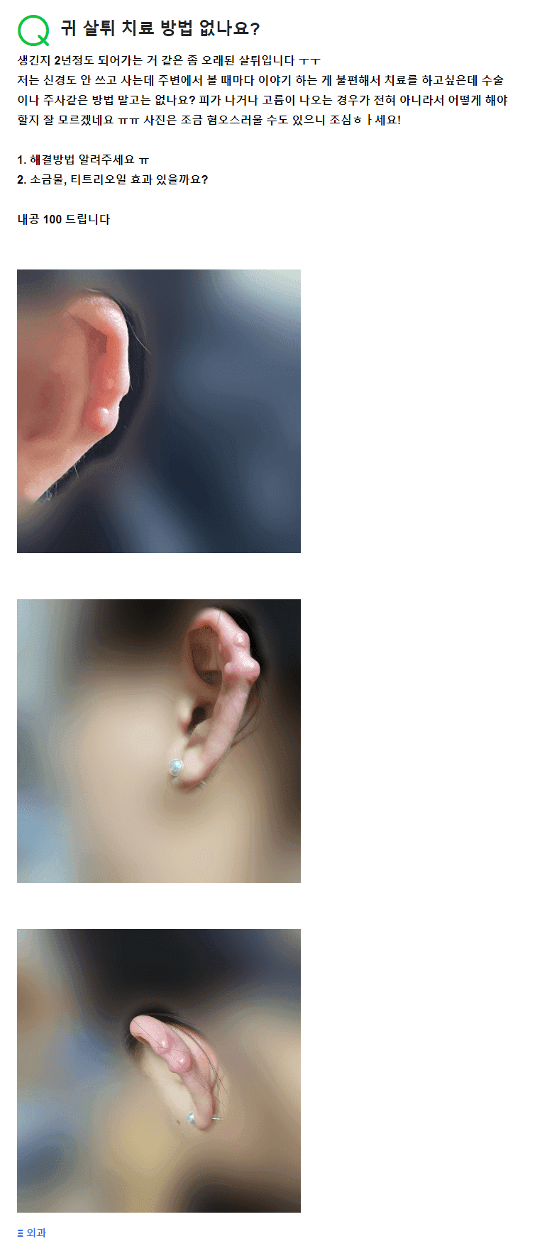ก้อนเนื้อบริเวณเจาะหู แผลเป็นนูนที่หูอายุ 2 ปี — จะหายไปได้ด้วยน้ำเกลือและน้ำมันทีทรีหรือไม่? ภาพที่เกี่ยวข้อง 2/2