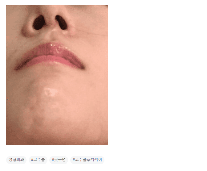 코수술 2주, 눈과 콧구멍이 짝짝이로 보인다면 — 지금 판단해도 될까? 관련 이미지 3/3