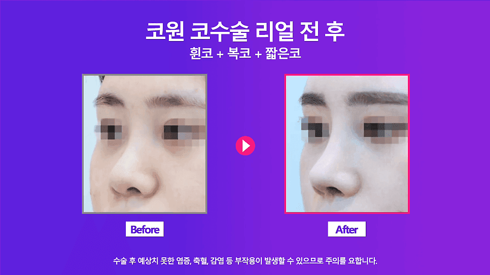 กรณีศึกษาการแก้ไขปลายจมูกกลมใหญ่ในผู้หญิง — เหตุใดจึงทำการรักษาการดูดฟิลเลอร์จมูกคดและจมูกสั้นพร้อมกัน ภาพที่เกี่ยวข้อง 7/8