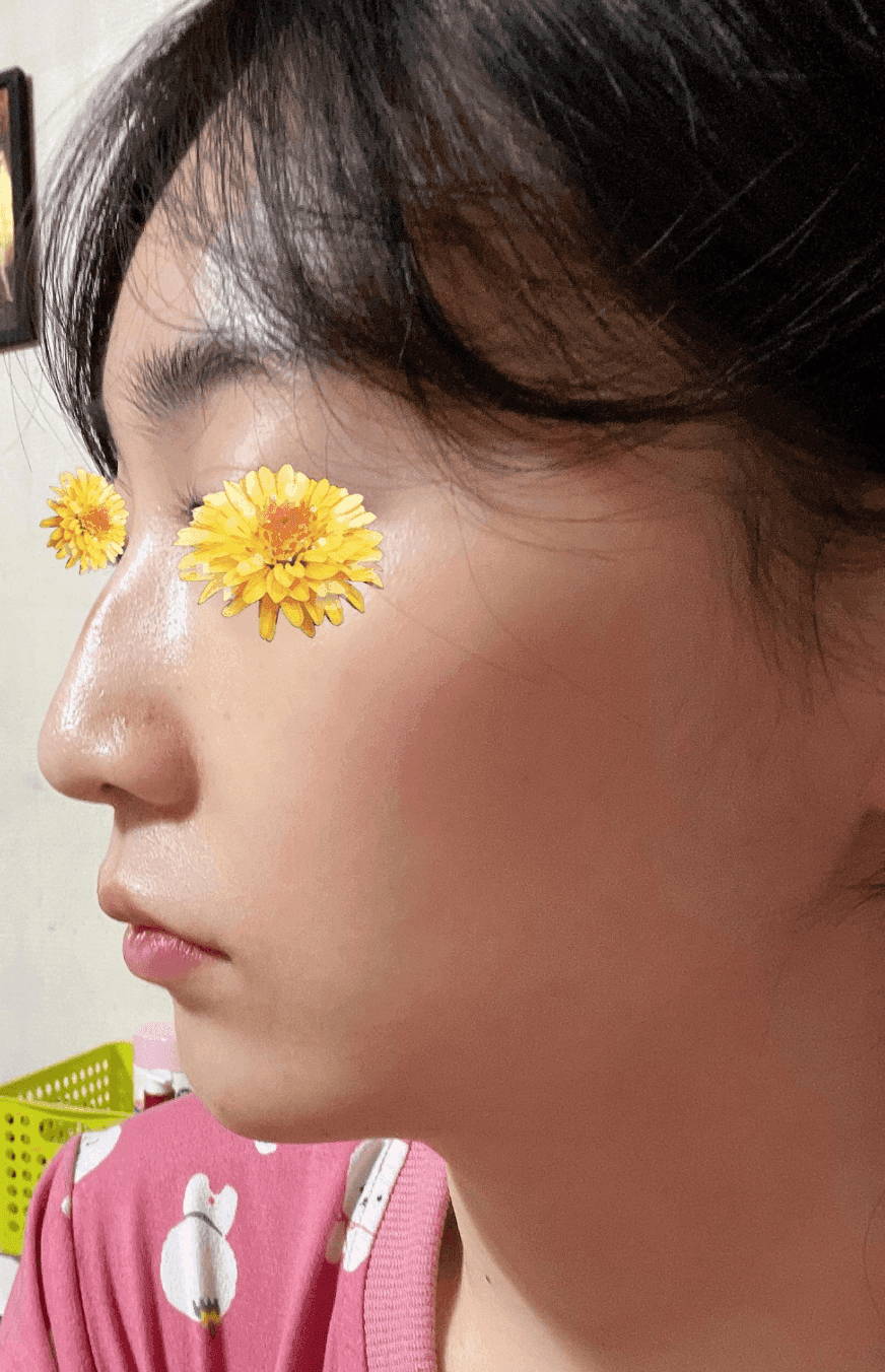 여자 매부리코에 처진 코끝까지 있다면 — 절골과 코끝내림근 교정을 함께 본 사례 관련 이미지 1/16