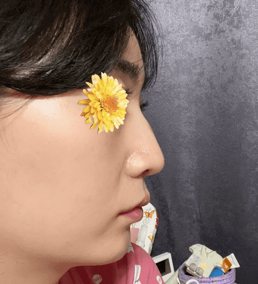 여자 매부리코에 처진 코끝까지 있다면 — 절골과 코끝내림근 교정을 함께 본 사례 관련 이미지 2/16