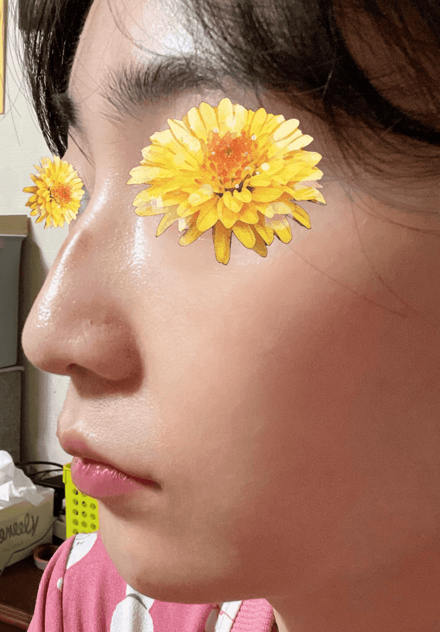 여자 매부리코에 처진 코끝까지 있다면 — 절골과 코끝내림근 교정을 함께 본 사례 관련 이미지 3/16