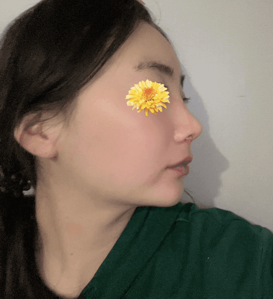 女性の鷲鼻に垂れた鼻先まであるなら——骨切りと鼻先下制筋矯正を一緒に見た事例 関連画像 5/16