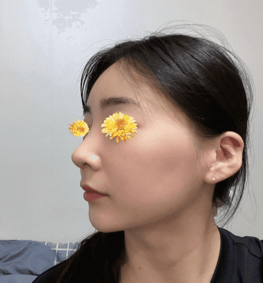 여자 매부리코에 처진 코끝까지 있다면 — 절골과 코끝내림근 교정을 함께 본 사례 관련 이미지 6/16
