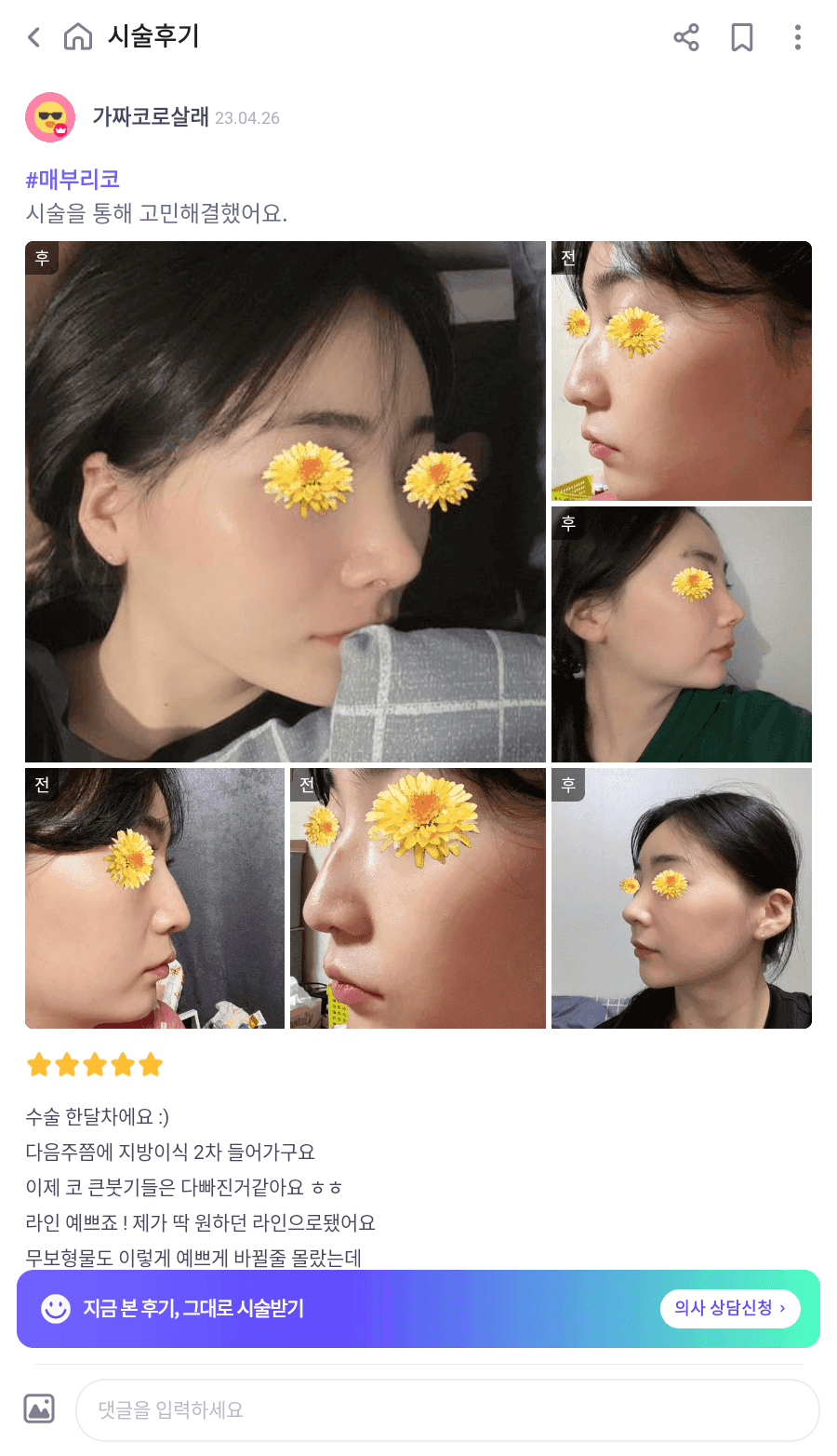 여자 매부리코에 처진 코끝까지 있다면 — 절골과 코끝내림근 교정을 함께 본 사례 관련 이미지 7/16