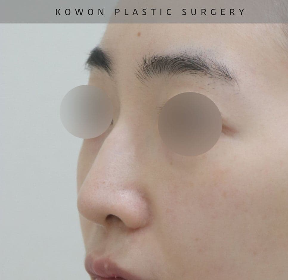 여자 매부리코에 처진 코끝까지 있다면 — 절골과 코끝내림근 교정을 함께 본 사례 관련 이미지 8/16