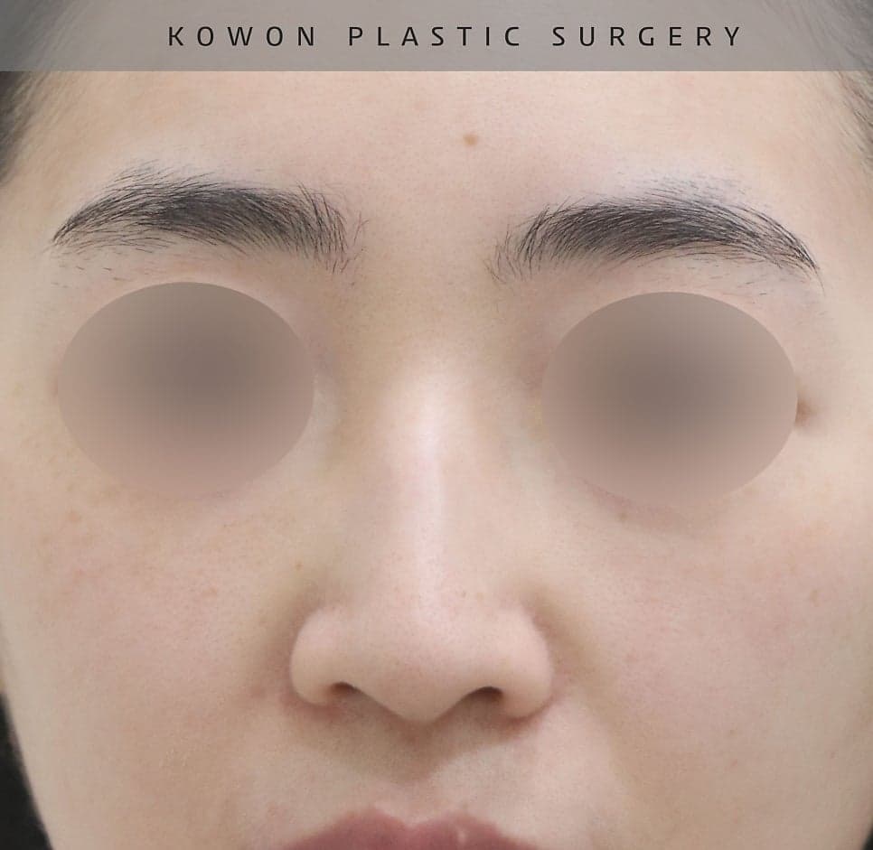 여자 매부리코에 처진 코끝까지 있다면 — 절골과 코끝내림근 교정을 함께 본 사례 관련 이미지 9/16