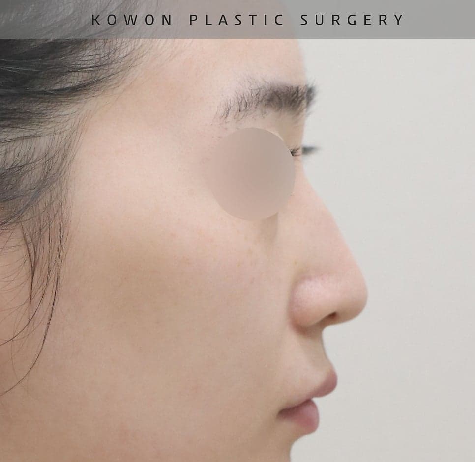 여자 매부리코에 처진 코끝까지 있다면 — 절골과 코끝내림근 교정을 함께 본 사례 관련 이미지 10/16