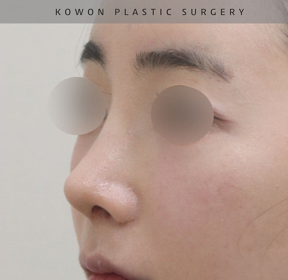 여자 매부리코에 처진 코끝까지 있다면 — 절골과 코끝내림근 교정을 함께 본 사례 관련 이미지 14/16