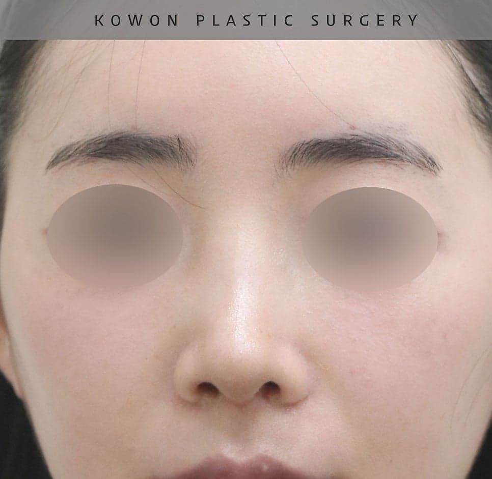 여자 매부리코에 처진 코끝까지 있다면 — 절골과 코끝내림근 교정을 함께 본 사례 관련 이미지 15/16
