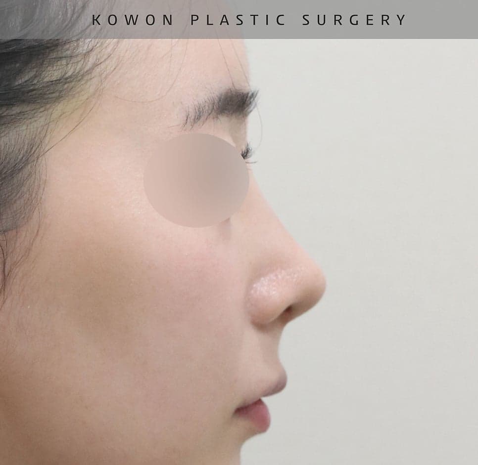 여자 매부리코에 처진 코끝까지 있다면 — 절골과 코끝내림근 교정을 함께 본 사례 관련 이미지 16/16