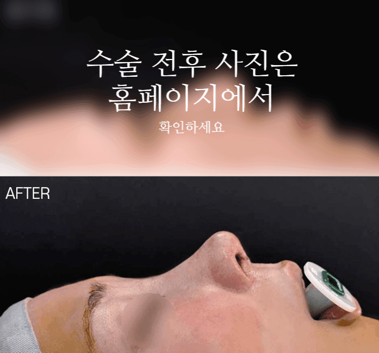 여자 매부리코에 복코까지 있다면 — 콧등과 코끝을 함께 계획해야 하는 이유 관련 이미지 2/9