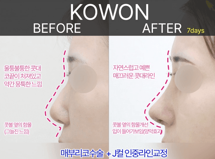 여자 매부리코에 복코까지 있다면 — 콧등과 코끝을 함께 계획해야 하는 이유 관련 이미지 4/9