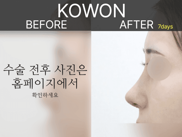 여자 매부리코에 복코까지 있다면 — 콧등과 코끝을 함께 계획해야 하는 이유 관련 이미지 5/9