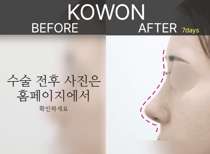 여자 매부리코에 복코까지 있다면 — 콧등과 코끝을 함께 계획해야 하는 이유 관련 이미지 6/9