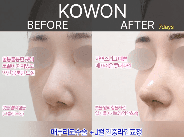 여자 매부리코에 복코까지 있다면 — 콧등과 코끝을 함께 계획해야 하는 이유 관련 이미지 7/9