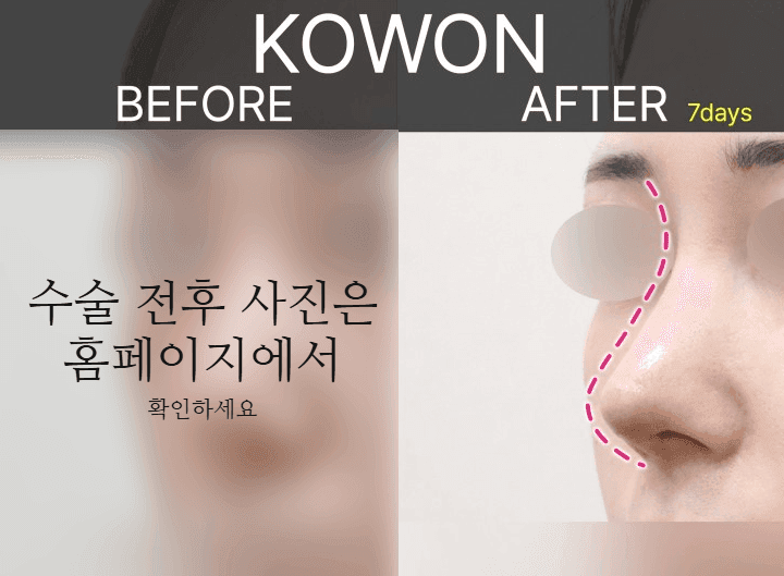 여자 매부리코에 복코까지 있다면 — 콧등과 코끝을 함께 계획해야 하는 이유 관련 이미지 8/9