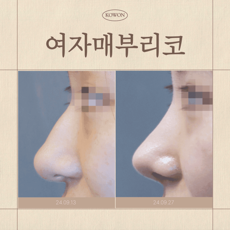 여자 매부리코, 무보형물 코수술로도 교정할 수 있나요? — 원인·자가진단·재료 선택 관련 이미지 1/8
