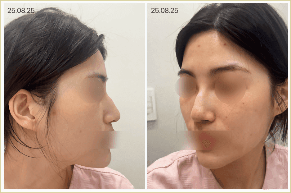 여자 매부리코, 무보형물 코수술로도 교정할 수 있나요? — 원인·자가진단·재료 선택 관련 이미지 2/8