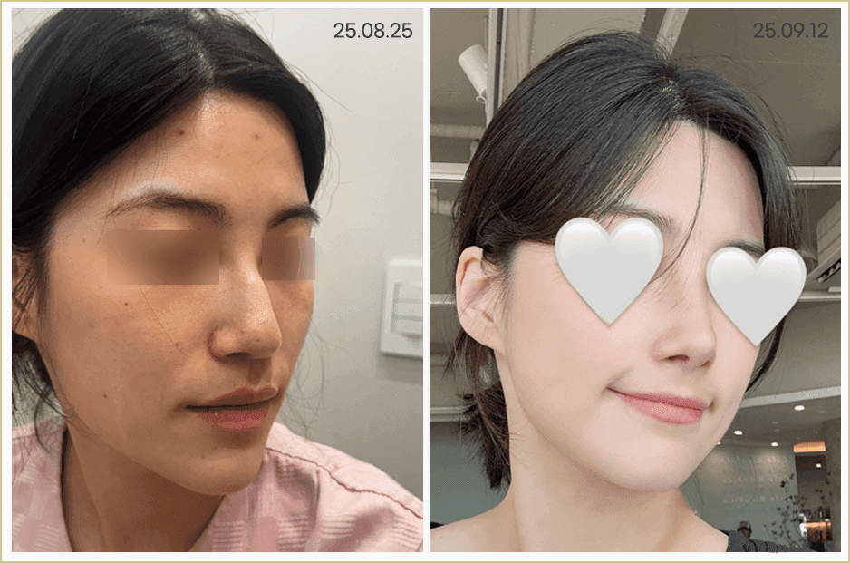 여자 매부리코, 무보형물 코수술로도 교정할 수 있나요? — 원인·자가진단·재료 선택 관련 이미지 7/8