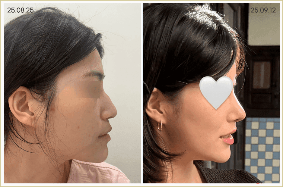 여자 매부리코, 무보형물 코수술로도 교정할 수 있나요? — 원인·자가진단·재료 선택 관련 이미지 8/8