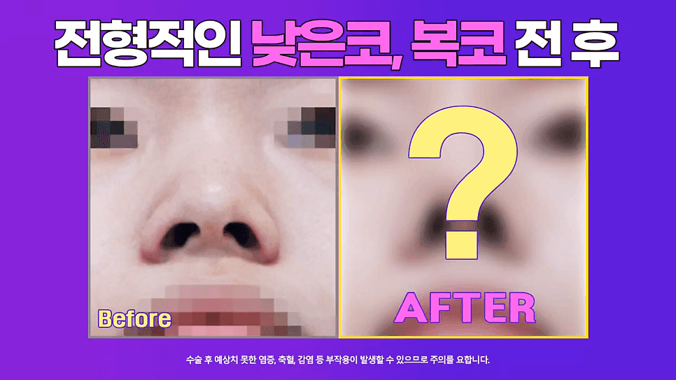 여자 낮은코 교정 사례 — 정면에서만 낮아 보이는 코, 비중격 연장과 절골술로 확인한 것 관련 이미지 1/8
