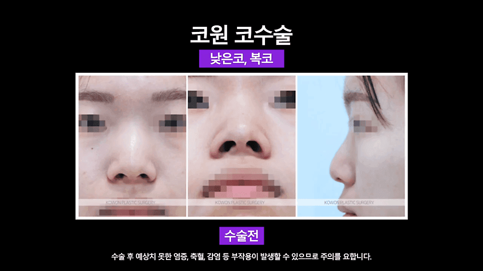여자 낮은코 교정 사례 — 정면에서만 낮아 보이는 코, 비중격 연장과 절골술로 확인한 것 관련 이미지 4/8