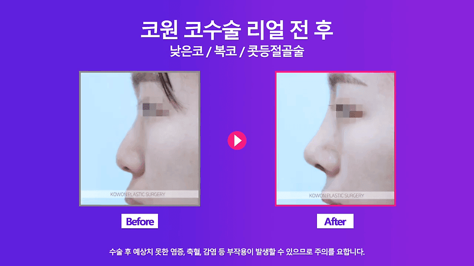 여자 낮은코 교정 사례 — 정면에서만 낮아 보이는 코, 비중격 연장과 절골술로 확인한 것 관련 이미지 5/8
